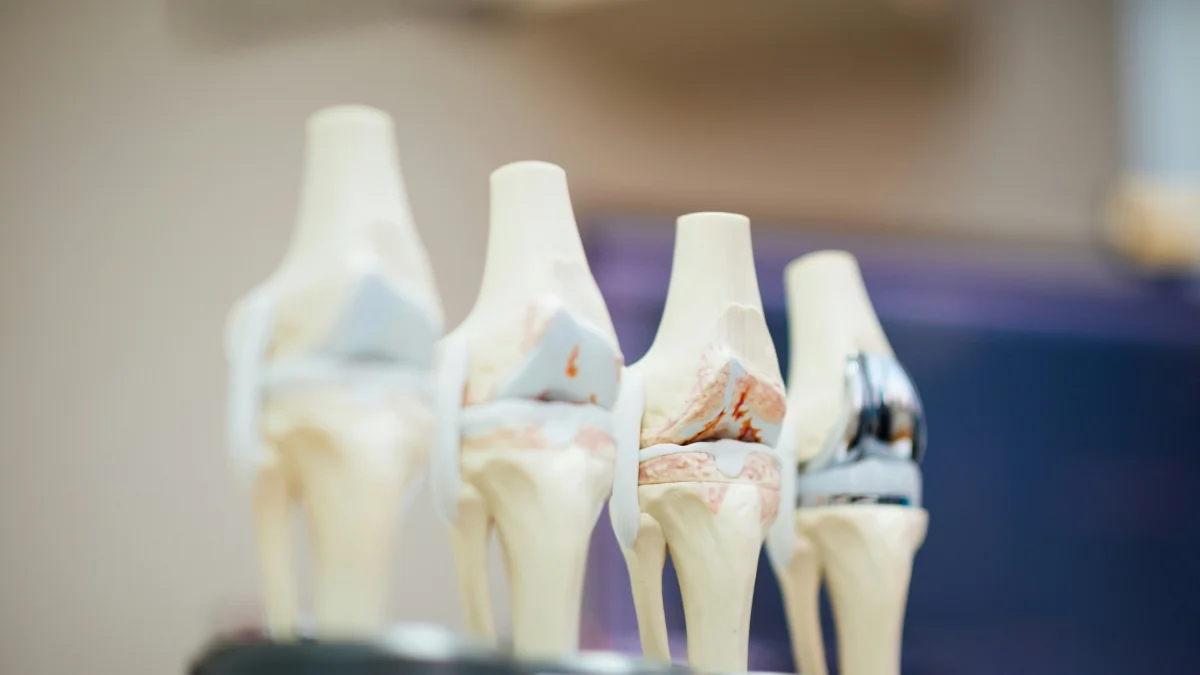 Pesquisa encontra partículas metálicas de próteses no cérebro humano