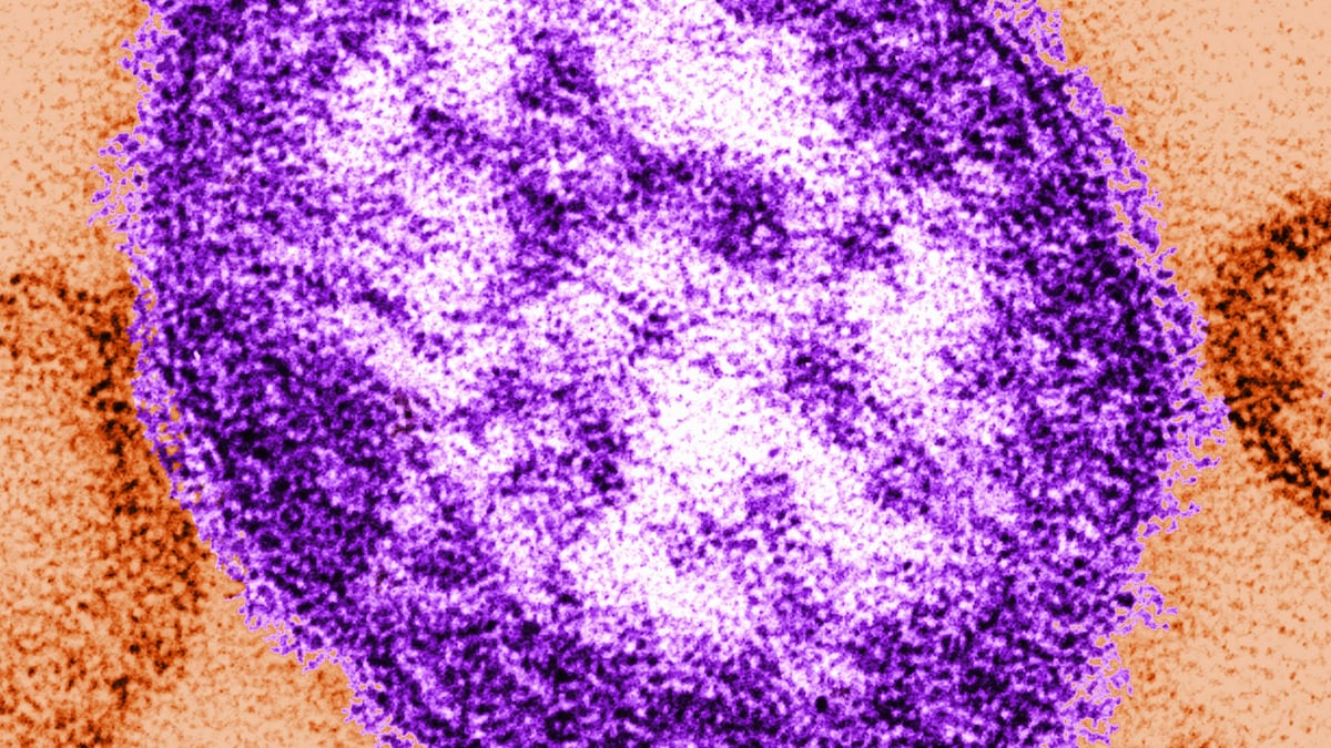 Ottawa Public Health alerting residents of possible measles exposure locations